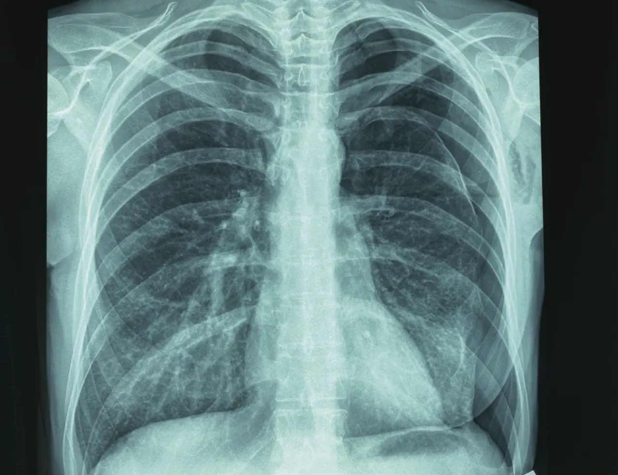 Slika 1. Radiografija grudnog koša na prijemu na kliniku na kojoj se verifikuje levostrani pneumotoraks Slika 1. Radiografija grudnog koša na prijemu na kliniku na kojoj se verifikuje levostrani pneumotoraks