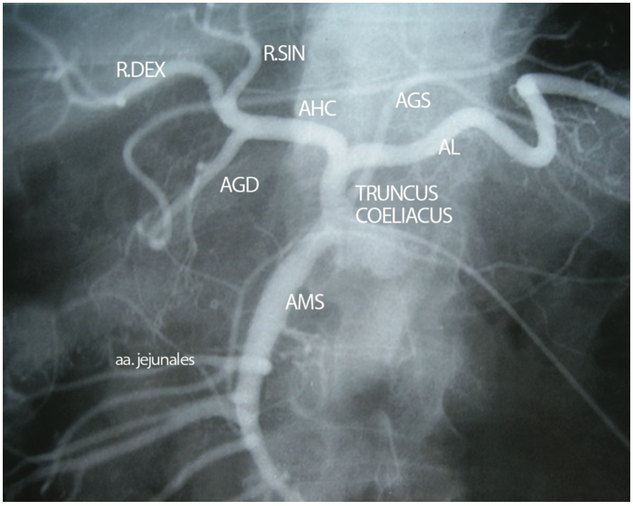 Slika 1. Truncus coeliacus, klasična trifurkacija: a. hepatica communis (AHC), a. lienalis (AL) i a. gastrica sinistra (AGS) (Izvor: Stojanović M. Aberantne jetrene arterije i njihov značaj. Magistarski rad)