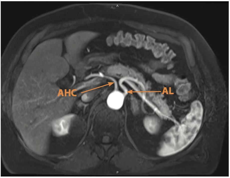 Slika 2. Nezavisna ishodišta zajedničke jetrene arterije (a. hepatica communis – AHC) i slezinske arterije (a. lienalis – AL), direktno iz abdominalne aorte Izvor: privatna dokumentacija