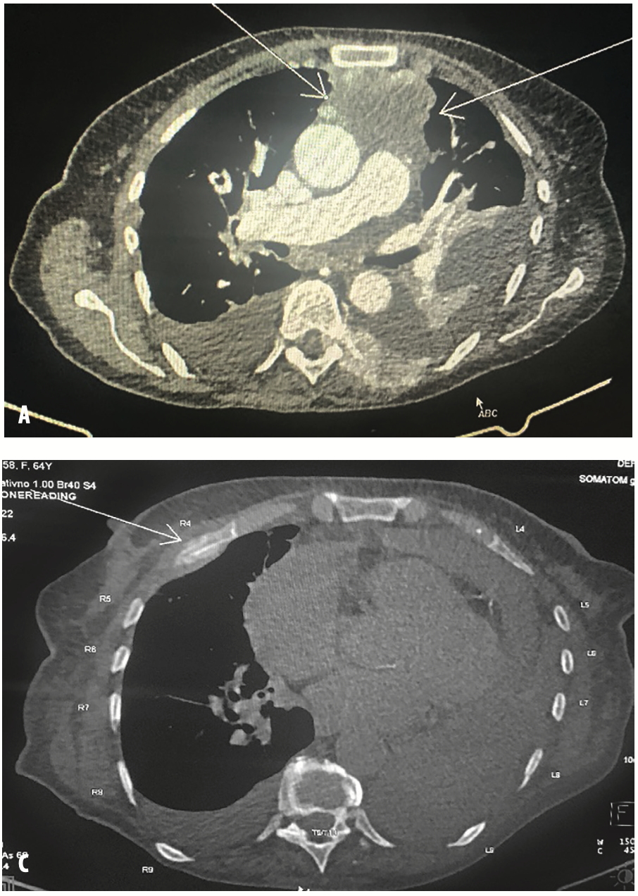 Slika 1. Multislajsna kompjuterizovana tomografija grudnog koša, abdomena i male karlice (engl. multi-slice computed tomography – MSCT) A) Konglomerati limfnih nodusa u medijastinumu; B) Metastatska promena u levoj nadbubrežnoj žlezdi; C) Metastatska promena u prednjem okrajku četvrtog rebra desno; D) Metastatske promene u zadnjem okrajku osmog rebra levo