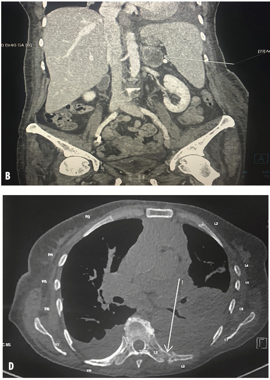 Slika 1. Multislajsna kompjuterizovana tomografija grudnog koša, abdomena i male karlice (engl. multi-slice computed tomography – MSCT) A) Konglomerati limfnih nodusa u medijastinumu; B) Metastatska promena u levoj nadbubrežnoj žlezdi; C) Metastatska promena u prednjem okrajku četvrtog rebra desno; D) Metastatske promene u zadnjem okrajku osmog rebra levo