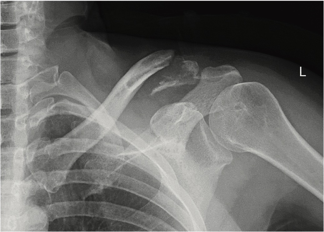 Slika 1. Preoperativna radiografija levog ramena u AP projekciji koja pokazuje prelom distalnog okrajka ključne kosti Neer IIB tipa