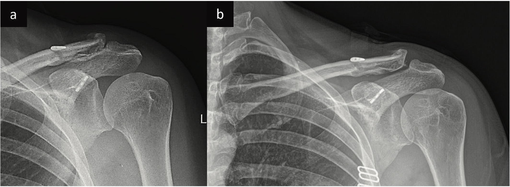 Slika 3. Postoperativne radiografije levog ramena u AP projekciji: a) nakon 14 dana od operacije; b) nakon šest nedelja od operacije