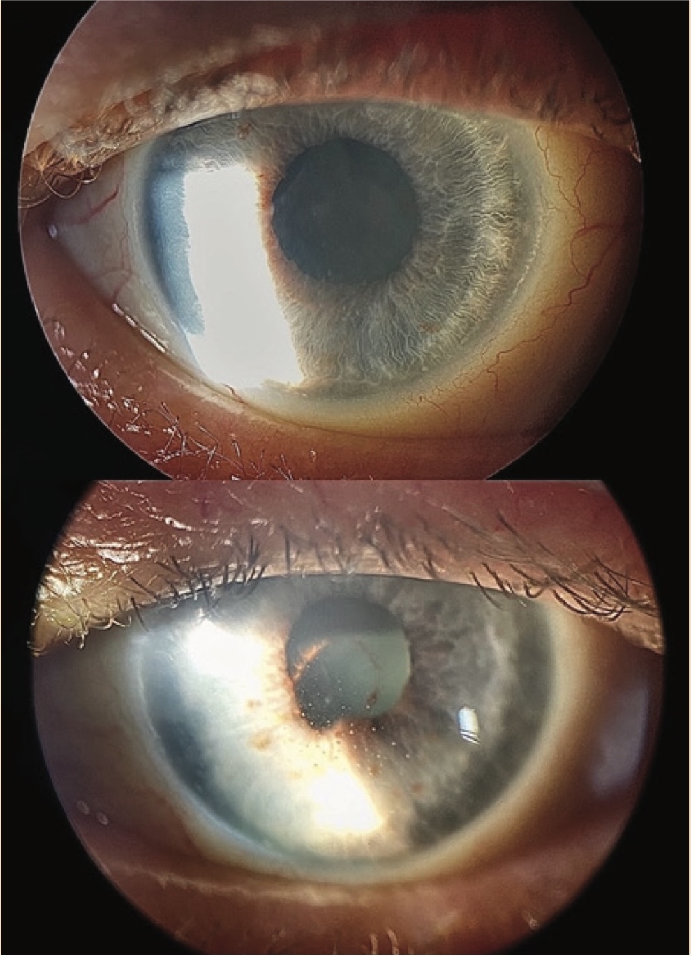 Picture 1. Anterior segment photographs of the right and left eyes at presentation.