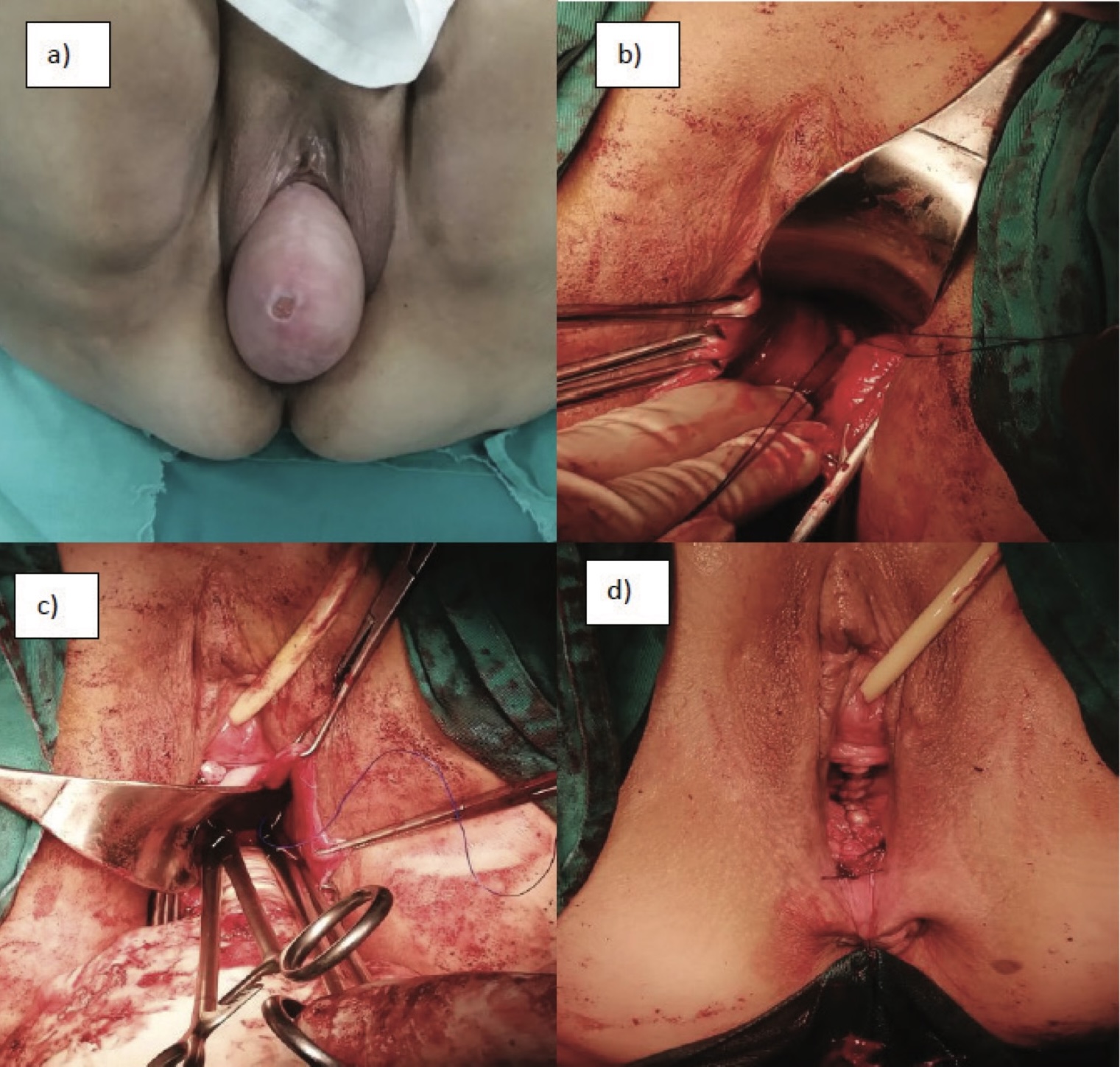 Slika 1. (a) Preoperativno stanje, desna (b) i leva (c) sakrospinalna fiksacija, (d) nakon operacije