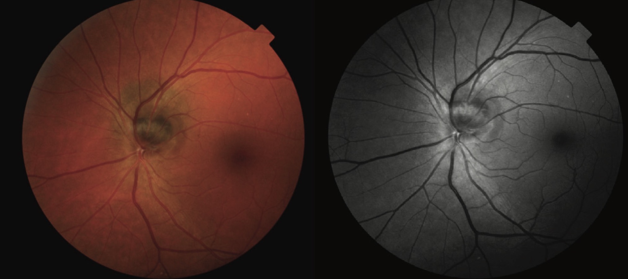 Figure 1. The image presents a fundus photograph of a melanocytoma located on the optic nerve head, accompanied by a juxtapapillary choroidal nevus. The melanocytoma is visible as a sharply demarcated, elevated, dark gray-black lesion on the optic disc, consistent with its characteristic pigmentation. Adjacent to the melanocytoma, the choroidal nevus appears as a flat, greenish-brown area with distinct borders