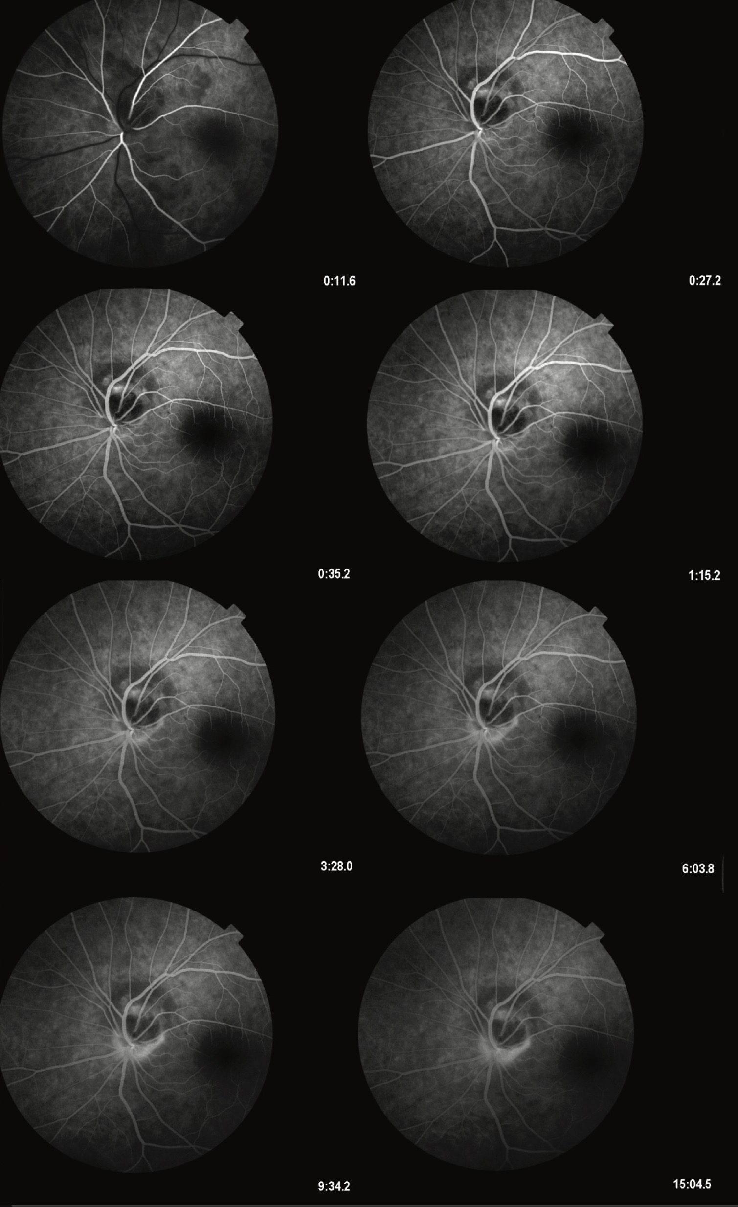Figure 2. This image depicts a series of frames from fluorescein angiography (FA) of a melanocytoma of the optic nerve head, accompanied by a juxtapapillary choroidal nevus. The angiographic sequence illustrates the absence of leakage or staining over the melanocytoma, consistent with its benign nature. The lesion appears as a dark, sharply demarcated area on the optic disc, causing blockage of fluorescence. Adjacent to the melanocytoma, the choroidal nevus is visible as a hypofluorescent area