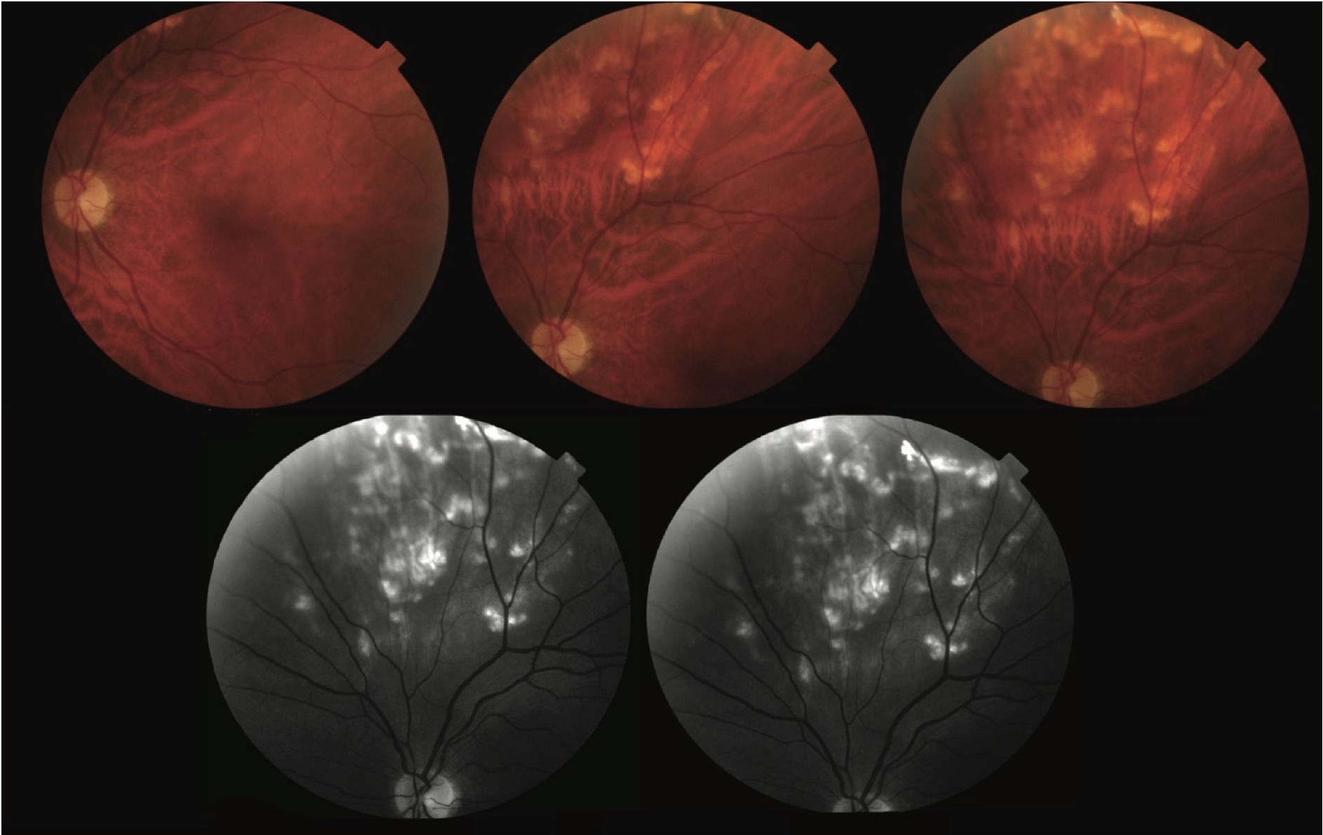 Figure 1. Fundus photograph of the left eye demonstrating a yellowish, placoid subretinal lesion with indistinct borders located suprapapillary, between the superior nasal and superior temporal vascular arcades. The lesion is consistent with sclerochoroidal calcification and appears elevated, without associated subretinal fluid, hemorrhage, or pigmentary changes. The surrounding retinal tissue, macula, and optic disc appear unremarkable