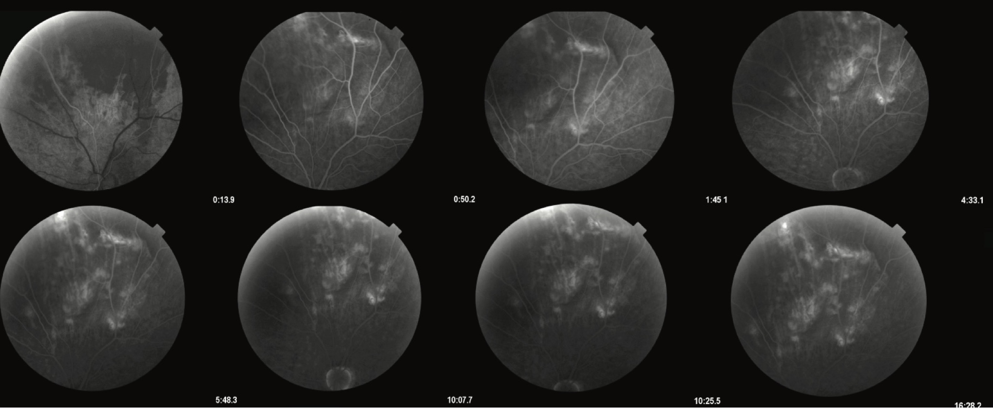 Figure 2. Fluorescein angiography of the left eye showing a hypofluorescent subretinal lesion located suprapapillary, between the superior vascular arcades. The lesion demonstrates absence of leakage or staining in both early and late phases, consistent with a benign, avascular process such as sclerochoroidal calcification