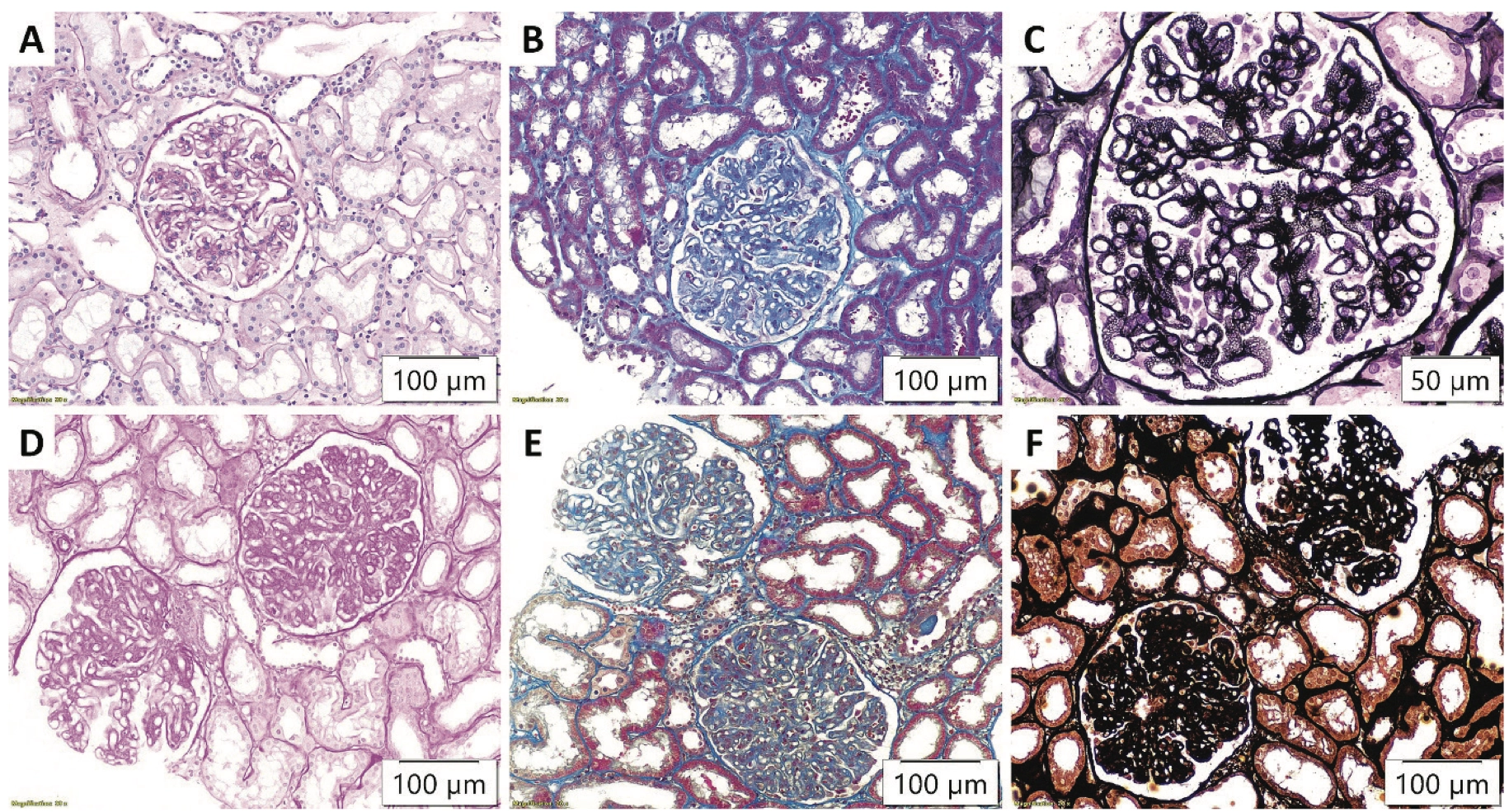 Slika 1. Promene u glomerulima na optičkoj mikroskopiji u primarnom (A) Periodic acid-Schiff (PAS), x200, (B) Masson’s trichrome stain (MTS), x200, (C) Jones methenamine silver (JMS), x400; i sekundarnom membranoznom glomerulonefritisu, sa uočenom endokapilarnom hipercelularnošću (D) PAS, x200, (E) MTS, x200, (F) JMS, x200