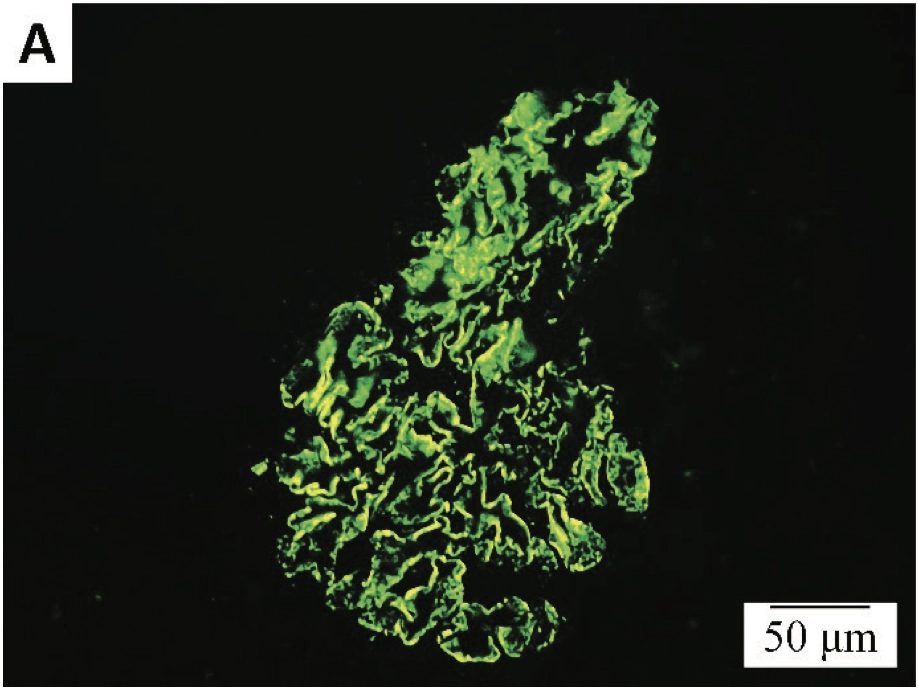Slika 2. Nalaz na imunofluorescentnoj mikroskopiji: sitnozrnasti depoziti (A) IgG i (B) C3 duž glomerularne bazalne membrane, x400