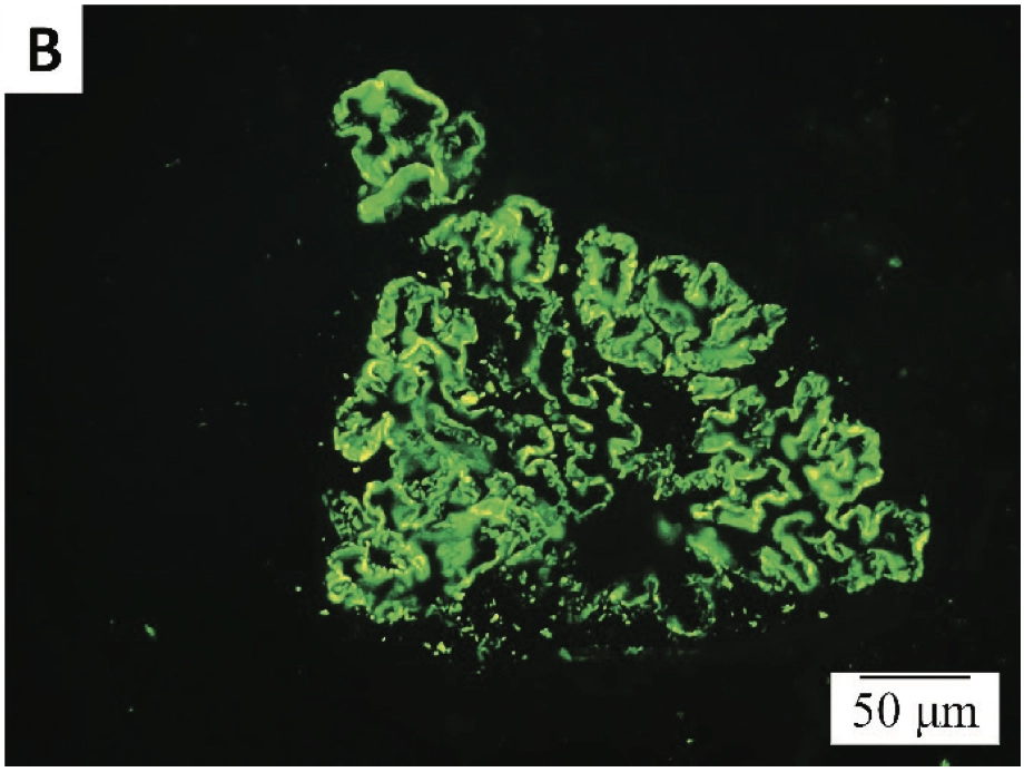 Slika 2. Nalaz na imunofluorescentnoj mikroskopiji: sitnozrnasti depoziti (A) IgG i (B) C3 duž glomerularne bazalne membrane, x400