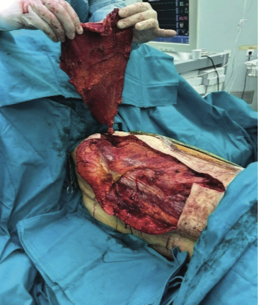 Slika 3. Odignut miokutani flap latisimusa – prva operacija